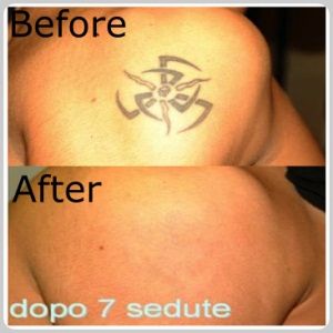 Tattoo Removal Pittsburgh - Removal how it works body 
